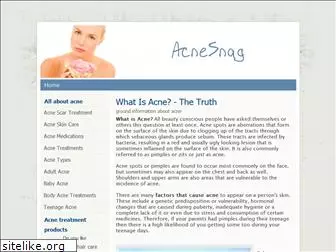acnesnag.com