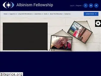 albinism.org.uk