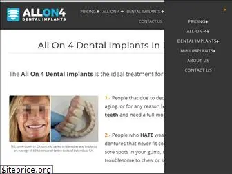 allon4dentalimplants.org