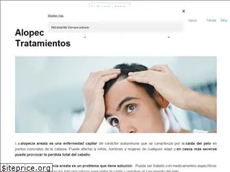 la-alopecia-areata.com