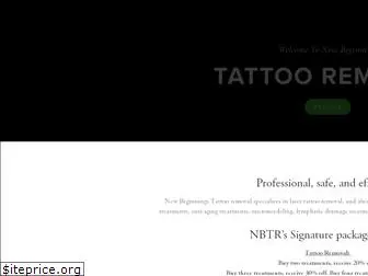 newbeginningstattooremoval.com