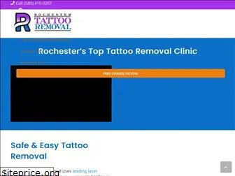 rochestertattooremoval.com