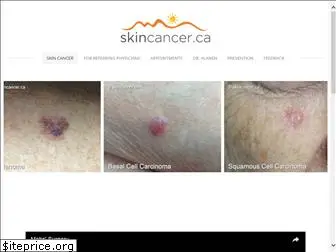 skincancer.ca