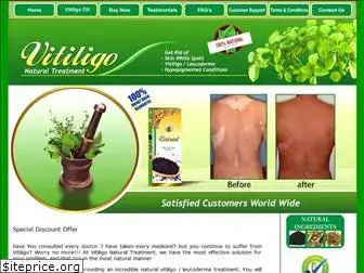 vitiligonaturaltreatment.com