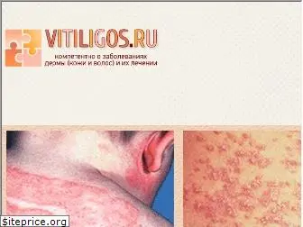 vitiligos.ru
